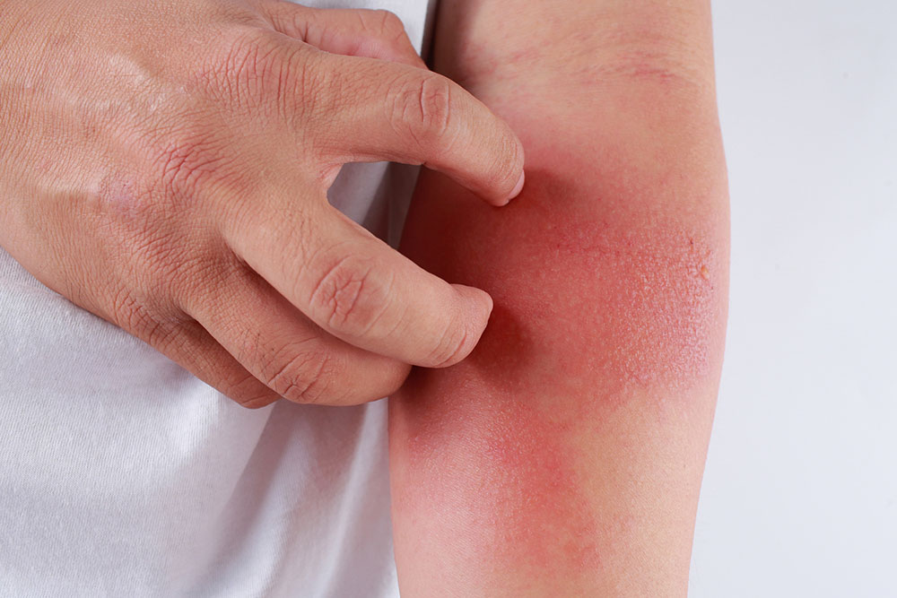 6 foods eczema patients must avoid