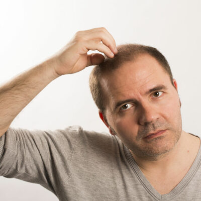 Male pattern baldness &#8211; How to detect and diagnose it