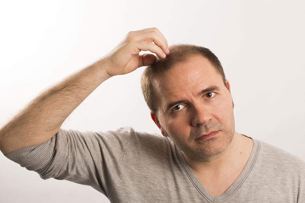 Male pattern baldness &#8211; How to detect and diagnose it